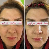 اولین مرکزتخصصی هایفو12بعدی(آراف تخصصی)خوزستان|خدمات آرایشگری و زیبایی|اهواز, زیتون کارمندی|دیوار