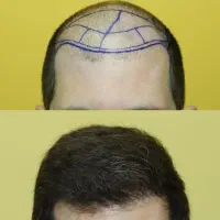 کاشت موی شیرازی