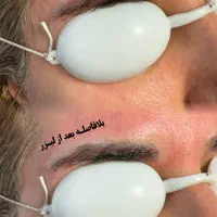 پاک کردن تتو با لیزر کیوسوییچ تضمینی|خدمات آرایشگری و زیبایی|تهران, نیروی هوایی (پیروزی)|دیوار