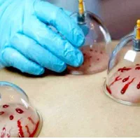 حجامت وفصد خون درمنزل در قرچک   پذیرفته میشود|خدمات آرایشگری و زیبایی|قرچک, |دیوار