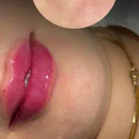 زیبایی ،بوتاکس .جوانساز