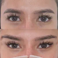 ژل‌.لیفت تخصصی صورت بانخ.افزایش سایزآلت تناسلی آقا