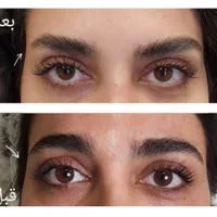 تزریق بوتاکس با بهترین متد|خدمات آرایشگری و زیبایی|مشهد, مصلی (کارمندان اول)|دیوار