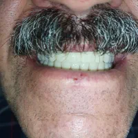 لابراتوار دندانسازی، دندان مصنوعی