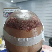 کاشت مو / ریش|خدمات آرایشگری و زیبایی|خرمآباد, |دیوار