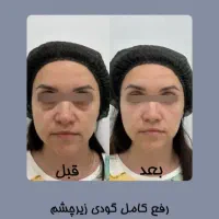 آف ویژه فیلر ، بوتاکس ، مزو ، نخ ، پی آر پی|خدمات آرایشگری و زیبایی|شیراز, قصرالدشت|دیوار