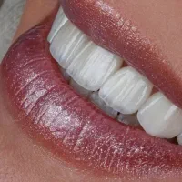 شرایط ویژه جشنواره دندانپزشکی ایمپلنت و اوردنچر