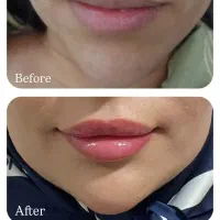 فیلرگونه چانه لب خط خنده زاویه بوتاکس مزوژل
