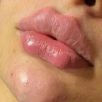 تزریق‌ژل ‌وبوتاکس‌‌واموزش‌