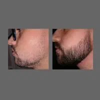 پرپشتی ریش در یک قدمی
