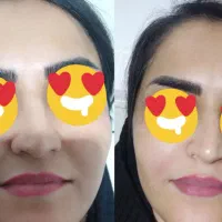 خدمات ژل‌ بوتاکس پی آر پی