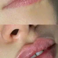 خدمات زیبایی (تزریق فیلر و بوتاکس)