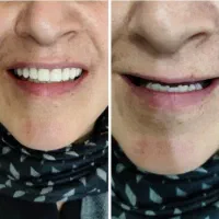 دندان مصنوعی اقساطی|خدمات آرایشگری و زیبایی|اصفهان, عطار نیشابوری|دیوار