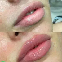 آموزش کامل تزریقات ژل و بوتاکس و آنزیم ۷۰۰۰/۰۰۰