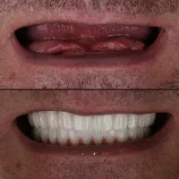 دندانپزشکی جشنواره ایمپلنت تخصصی