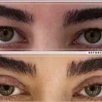 بلفاروپلاستی/ دایرکت ابرو