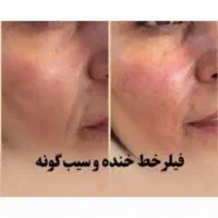 جشنواره تززیق فیلر،ژل وبوتاکس درهفده شهریور|خدمات آرایشگری و زیبایی|تبریز, |دیوار