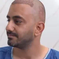 کاشت مو پر تراکم  تضمینی فقط 20 تومن|خدمات آرایشگری و زیبایی|رشت, بلوار گیلان|دیوار