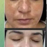 درمان مشکلات پوستی اگزما لک|آرایشی، بهداشتی، درمانی|سرخنکلاته, |دیوار