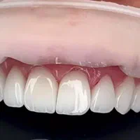 کامپوزیت دندان تخفیف ویژه روکش دندانپزشکی تهرانسر|خدمات آرایشگری و زیبایی|تهران, تهرانسر مرکزی|دیوار