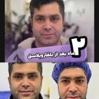 جراحی بلفاروپلاستی(رفع افتادگی پلک)بوکال فت/ساکشن|خدمات آرایشگری و زیبایی|تهران, هفت حوض|دیوار