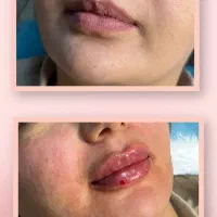 تزریق فیلر بوتاکس جوانسازی