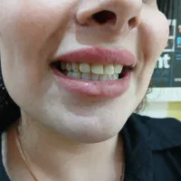 فرصت استثنایی کامپوزیت زیبایی به مدت 3 روز