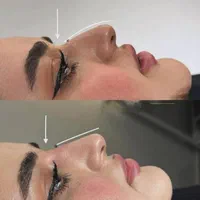 فیلر بینی  برطرف کردن قوز بینی  بینی شکسته و کج|خدمات آرایشگری و زیبایی|خرم‌آباد, |دیوار