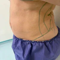 لیپوماتیک شکم و باسن با تخفیف ویژه