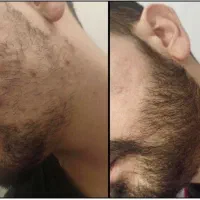 نه به کاشت