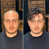 نصب انواع پروتز مو طبیعی، فروش چسب و ریمور