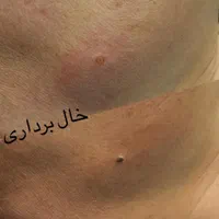 رفع جای جوش ،ریزش مو ،خال برداری برای آقایان|خدمات آرایشگری و زیبایی|خرمشهر, |دیوار