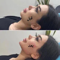 جشنواره  تزریق چربی لیزر لاغری ژل بوتاکس|خدمات آرایشگری و زیبایی|تهران, هفت حوض|دیوار