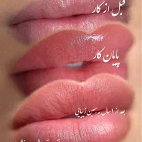 فرصت طلایی شیدینگ و شیدلب لیپس برطرف کردن کبودی لب