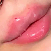 فیلر بوتاکس500 ژل لب فیلر بینی آنزیم فیلر بادی