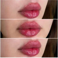 ژل لب بوتاکس فیلر آنزیم کانتورینگ توسط پزشک فقط۶۵۰