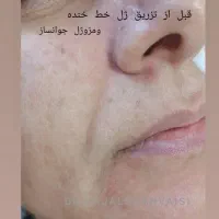 مطب زیبایی دکتر کژال شاه ویسی تزریق ژل بوتاکس..|خدمات آرایشگری و زیبایی|سنندج, |دیوار