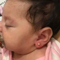 سوراخ کردن گوش با دستگاه ، کیلینیک زیبایی