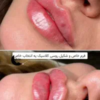 فیلرلب باتکنیک روز ،کانتورینگ،بوتاکس وانواع مزوژل