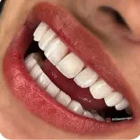 کامپوزیت طبیعی با تکنیک لیرینگ
