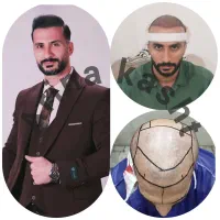 جشنواره کاشت مو فول تراکم تضمینی بادارو و آزمایش