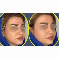 جشنواره ژل و بوتاکس،فیلر،پی آرپی،لاغری توسط پزشک