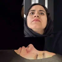 جراحی تیپ پلاستی بینی با ۱۰ میلیون تخفیف