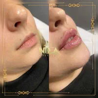 تزریق بوتاکس و فیلر با تخفیف ویژه