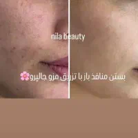 تزریق فیلر وبوتاکس وجوانساز صورت|خدمات آرایشگری و زیبایی|کارون, |دیوار