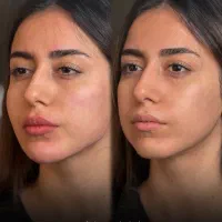ژل بوتاکس فیلر مزو پی ار پی(آموزش ژل بوتاکس)