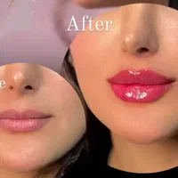 تزریق ژل و بوتاکس|خدمات آرایشگری و زیبایی|تهران, عبدل‌آباد|دیوار