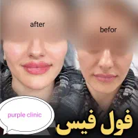 بوتاکس رایگان با انجام دو سی سی فیلر پیروزی|خدمات آرایشگری و زیبایی|تهران, چهارصد دستگاه|دیوار