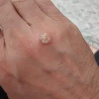 رفع hpv