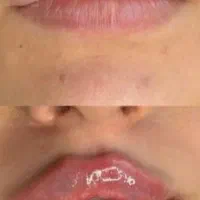 کاشت مو و کاشت ابرو اقساطی و تضمینی|خدمات آرایشگری و زیبایی|ارومیه, |دیوار